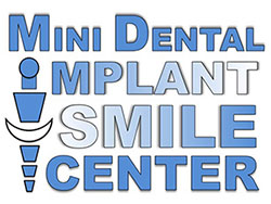 Mini Dental Implant Dentist Near Me San Diego, CA