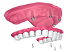 Dentaduras postizas soportadas por implantes