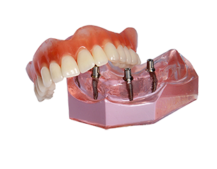 Great-on-8-Mini Dental Implants